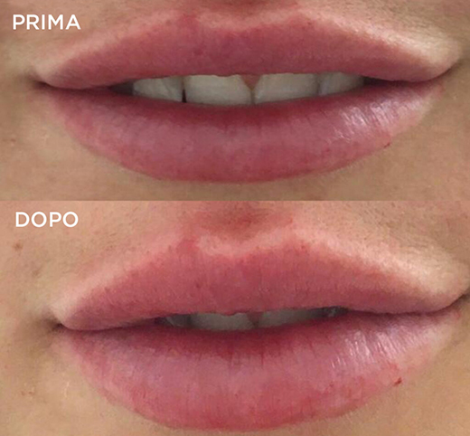 filler-labbra-fb-1024×1024