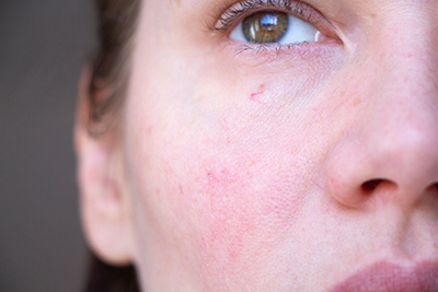 The,Girl,Has,Red,Capillaries,On,Her,Face