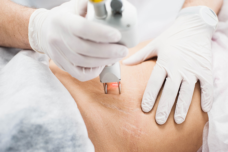 The,Doctor,Makes,A,Laser,Correction,Of,Stretch,Marks,On